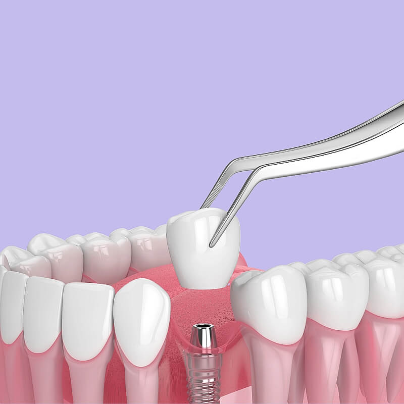 Nemokama nuotolinė konsultacija dėl dantų implantacijos