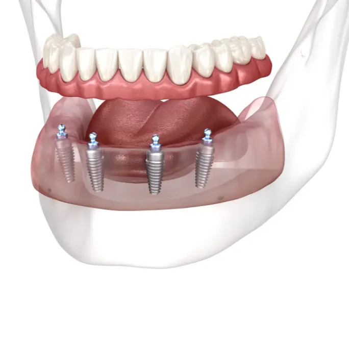 NEMOKAMA konsultacija dėl dantų implantacijos + gydymo plano sudarymas