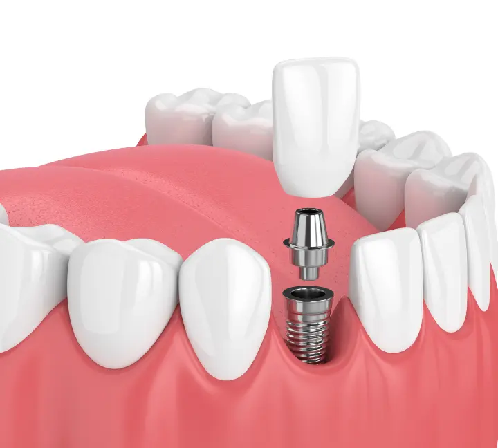 Dantų implantai Vilniuje: kur atlikti implantaciją, kiek ji kainuoja ir kaip pasirinkti implantą?